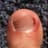 Ingrown Toenail