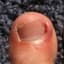 Ingrown Toenail
