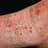 Eczema