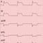 STelevation myocardic infarction
